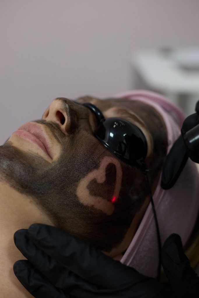Carbon Peeling Tatabányán – Hollywood Peel ragyogó bőrért - Beauty Shape