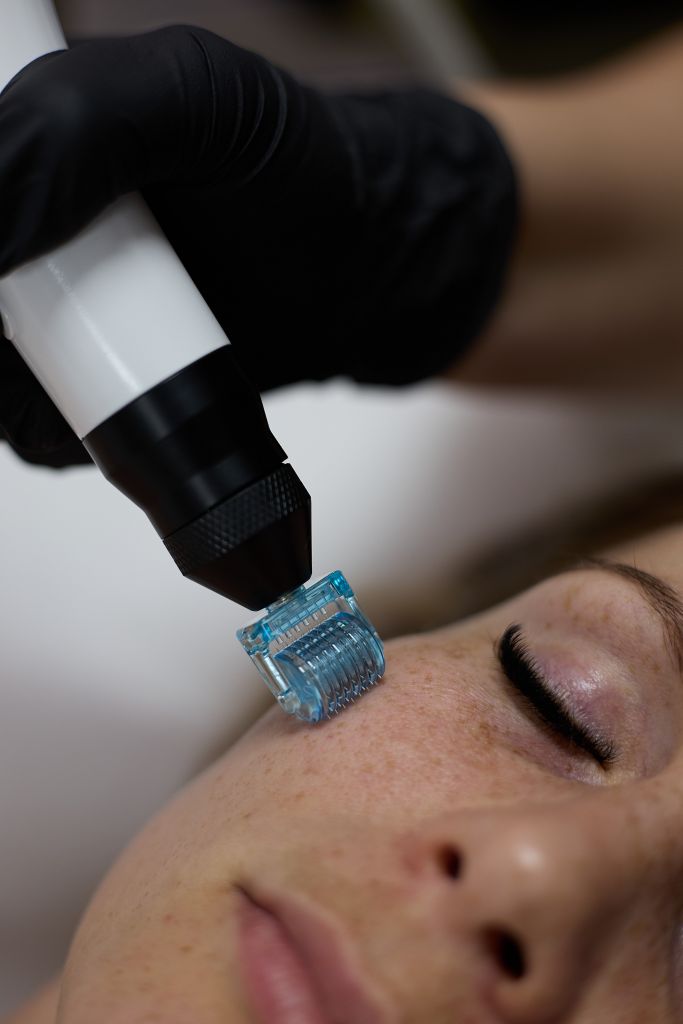 Hideg plazma kezelés Tatabányán – aknéra és hajhullásra - Beauty Shape Tatabánya