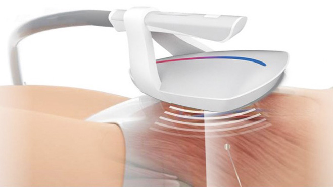 HIEMT RF alakformálás Tatabányán – Zsírégetés és izomépítés | BeautyShape