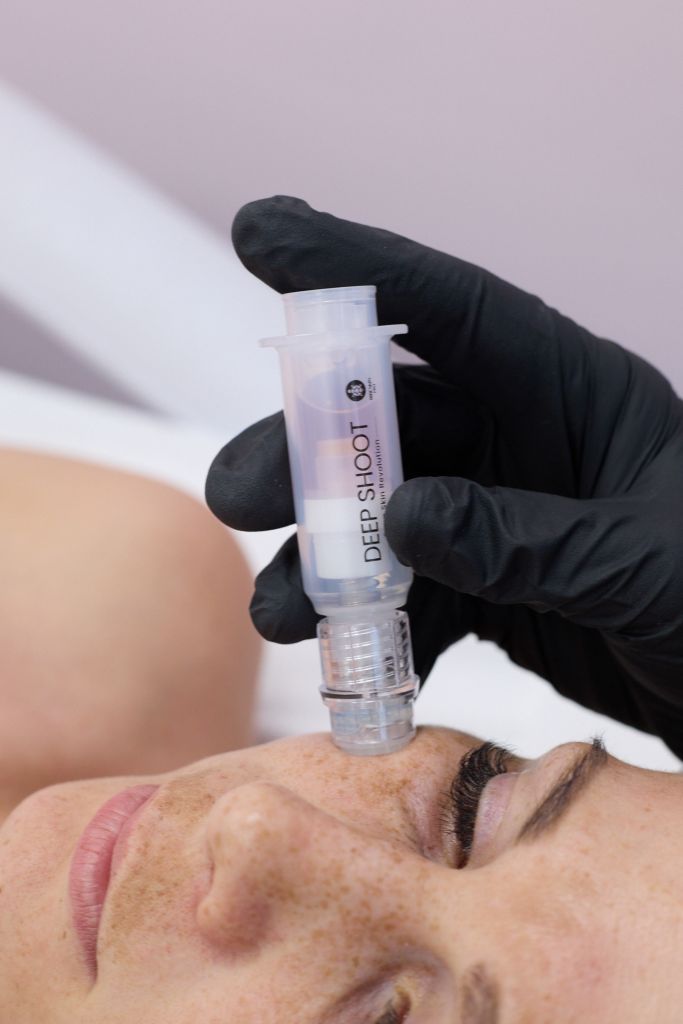 Deep Shoot AA kezelés Tatabányán – anti-aging és feszesítés: Beauty Shape