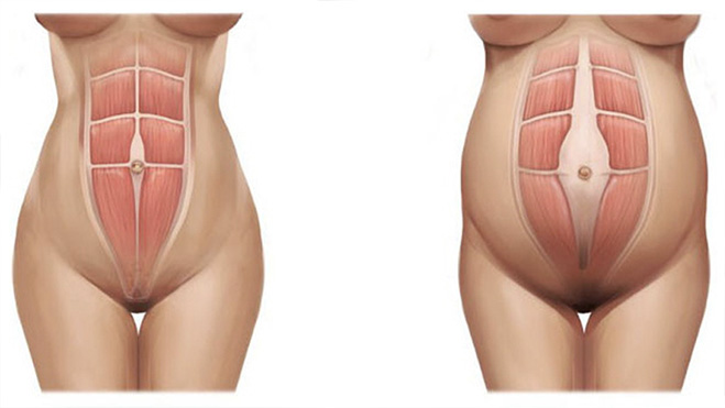 Szétnyílt hasizom kezelése Tatabáynán, Beauty Shape